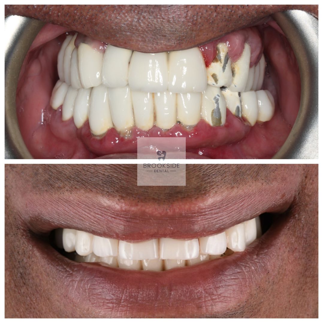 The best dental implants in Market Harborough Replace missing teeth